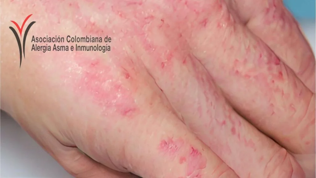 Dermatitis Atópica